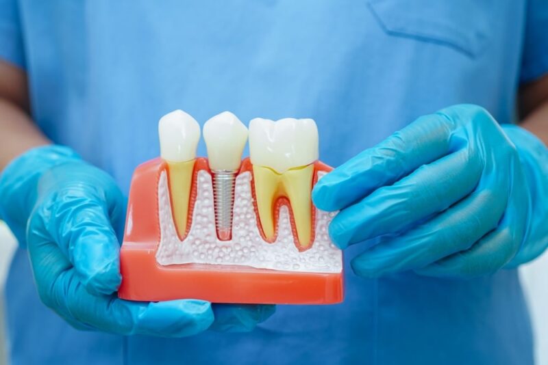 Dental Implants mill valley